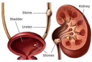 Readycure Ayurveda Kidney Stone 