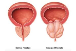 Readycure Ayurveda Prostatitis