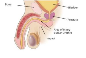 Readycure Ayurveda Urethral Stricture